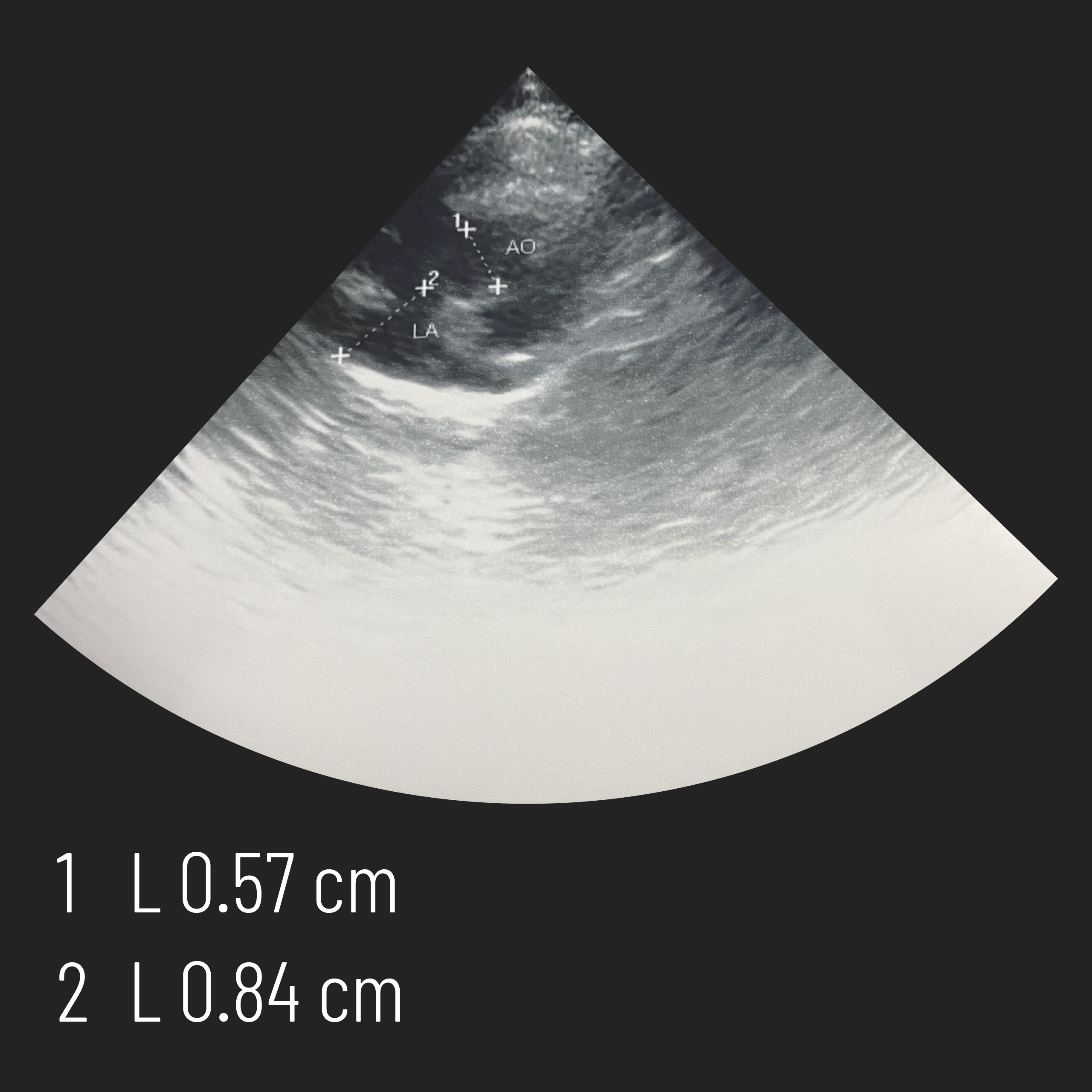 実際のエコー画像-腎臓